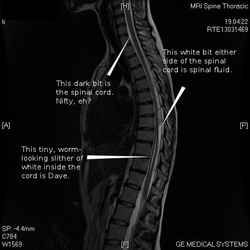 spinal cord with parts marked