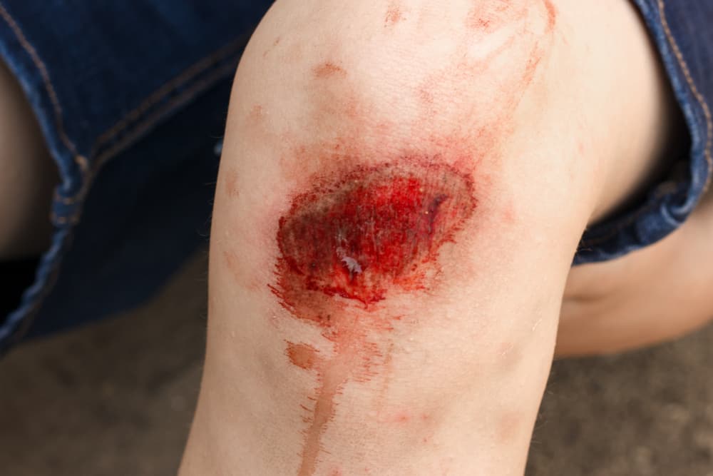 A severe abrasion commonly referred to as "road rash," which is often sustained during a fall on a rough surface.