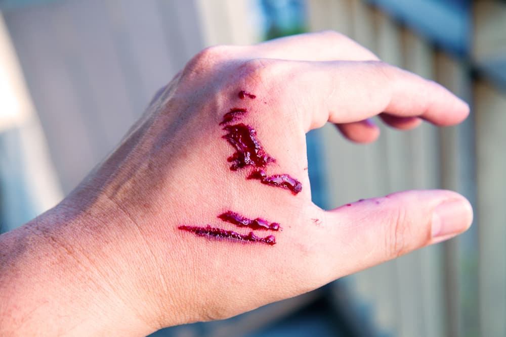 Una herida por mordedura de perro y sangre en la mano.